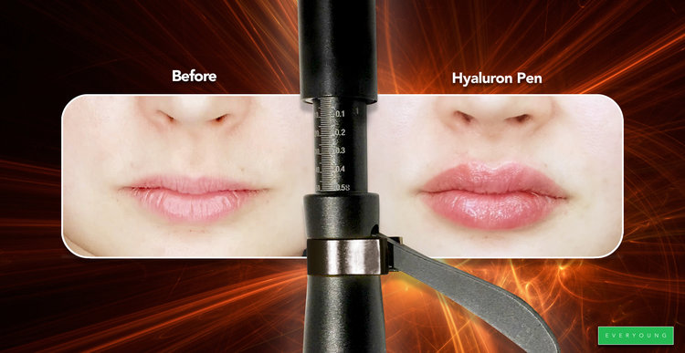 Vet tong eb Skin Deep | The Hyaluron Pen – The Quick, Easy, and Safe Way to Luscious,  Youthful Lips!
